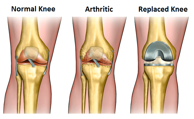 knee replacement operation types