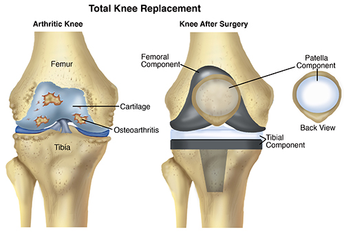 total Knee Replacement digram