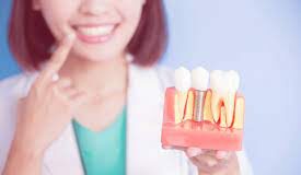 The Benefits Of Getting Dental Implants
