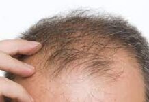 Hair Loss and Medications: Common Drugs That May Affect Your Hair Health
