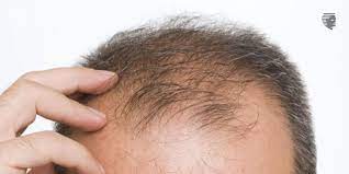 Hair Loss and Medications: Common Drugs That May Affect Your Hair Health